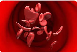 Sickle cell disease project: drawing of red blood cells, some sickle-shaped