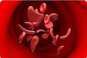Sickle cell disease project: drawing of red blood cells, some sickle-shaped