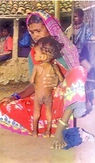 Severely malnourished child